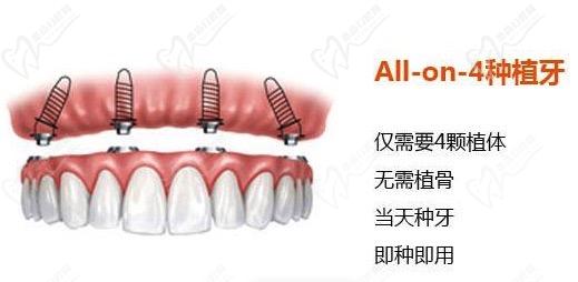 天津瑞景口腔门诊部种植牙