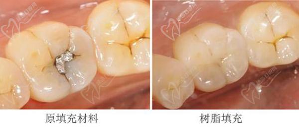 补牙600一颗是不是被骗了