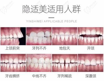 隐适美适用人群