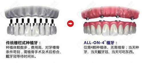 allon4种植牙可以用多少年