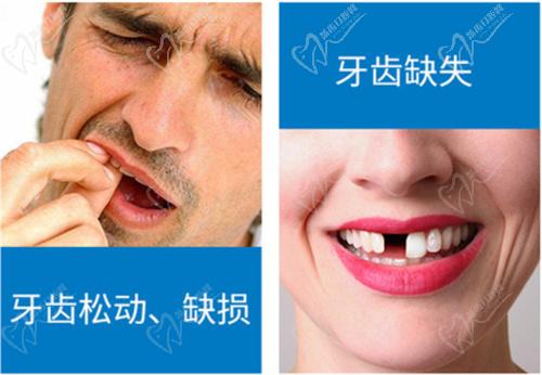 牙齿缺失 牙齿缺失