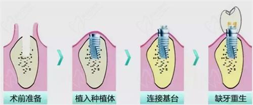 种植牙步骤 种植牙步骤