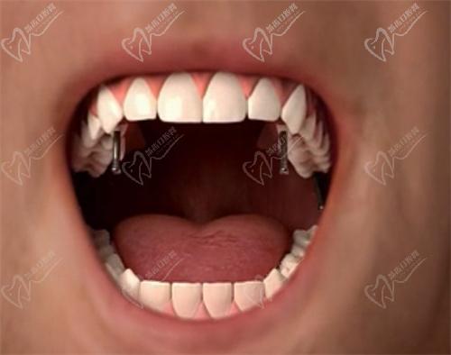 牙齿种植 牙齿种植