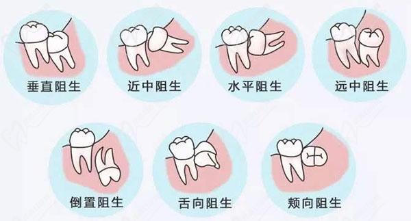 良心医生不建议拔智齿是因为拔智齿后遗症太多了吗