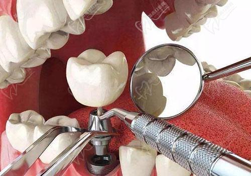 三维即刻种植牙