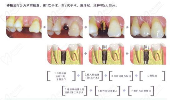 种植牙流程示意图