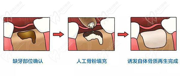 骨量不足怎么做种植牙