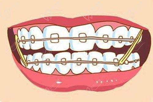牙齿托槽矫正动漫图