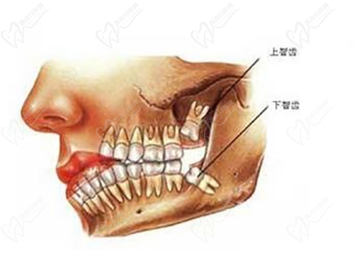 拔智齿会有后遗症