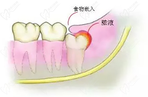 智齿每隔一段时间就发炎怎么办