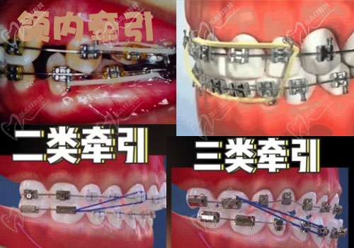 牙齿矫正挂皮筋图解