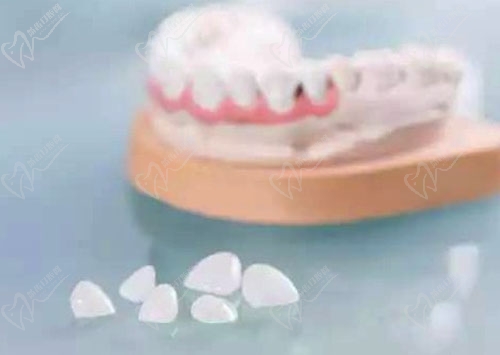 牙齿贴面技术