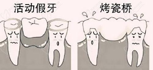 镶牙