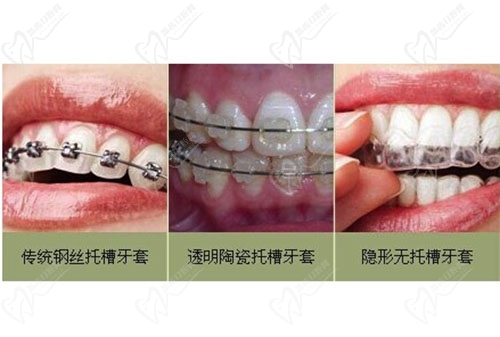 牙齿矫正不同类型