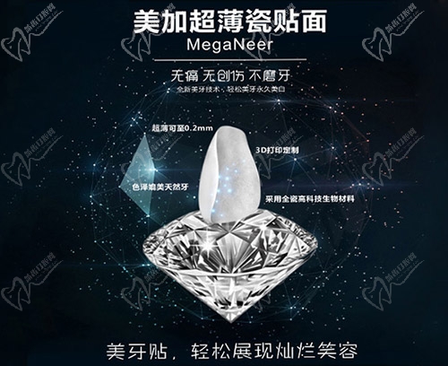 美加超薄瓷贴面