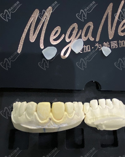 美加瓷贴面