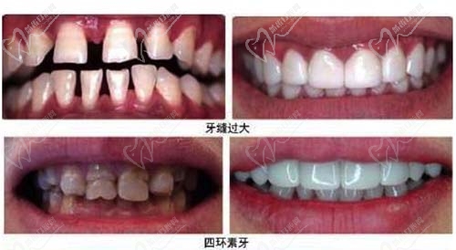 牙贴面适应症部分类型