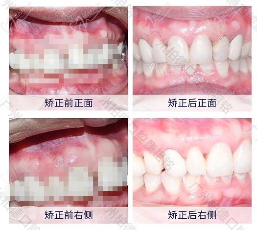 广州柏德口腔矫正后
