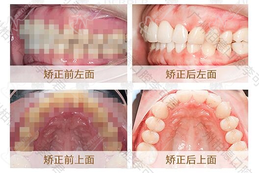 广州柏德口腔正畸术后