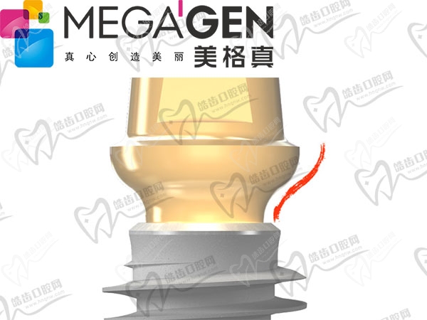 韩国美格真种植牙好不好