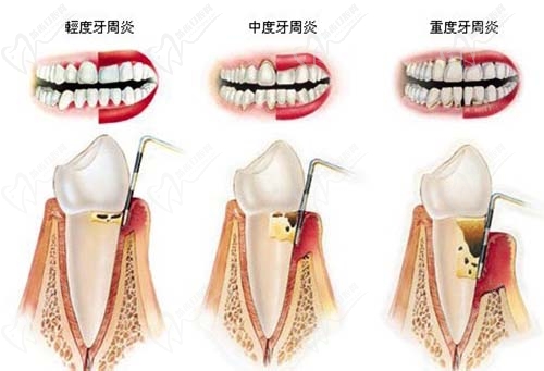 牙周炎发展过程