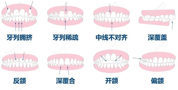 牙齿矫正多少岁合适
