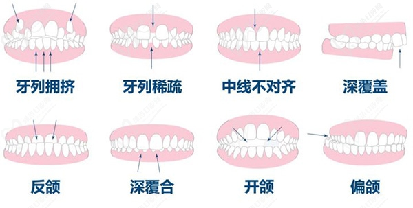 牙齿矫正多少岁合适