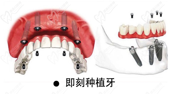 即刻种植牙