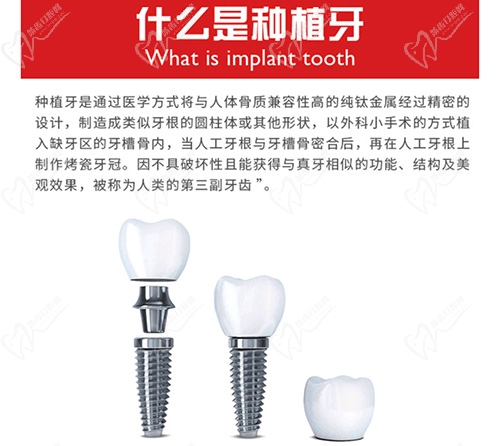 种植牙是什么