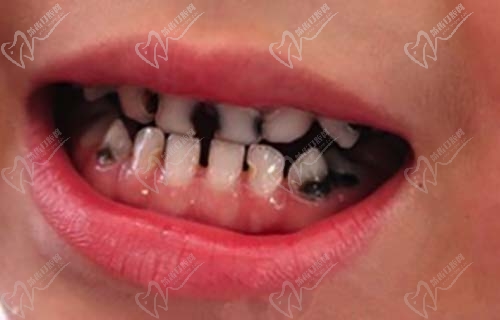儿童牙齿龋坏过深