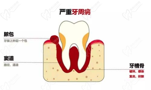 牙周疾病示意图