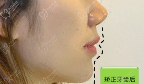 深圳美莱韩旭医生做牙齿矫正后侧面照