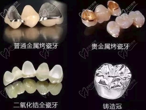 全瓷牙种类