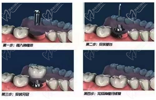 牙齿种植详细步骤