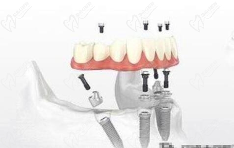 上海雅悦齿科即刻负重种植