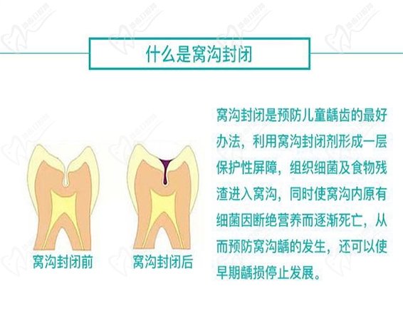 窝沟封闭