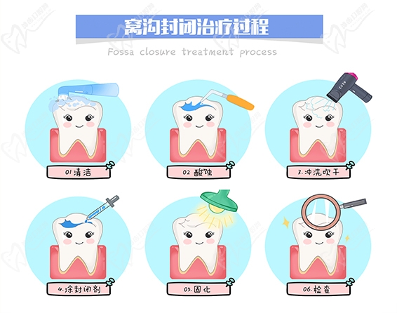 窝沟封闭过程
