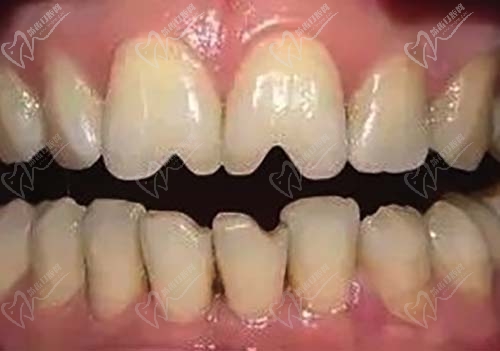 轻微牙齿缺损适合牙齿贴面