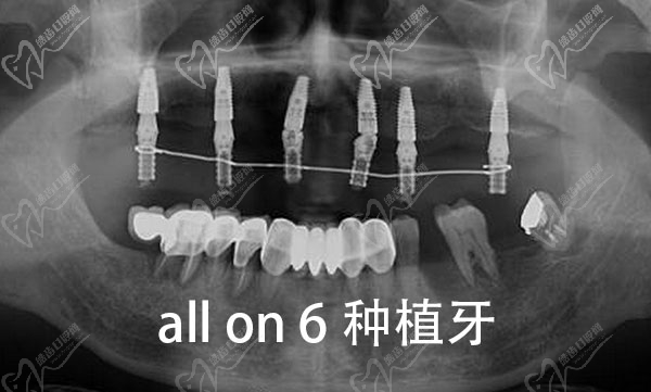 半口6颗种植牙图