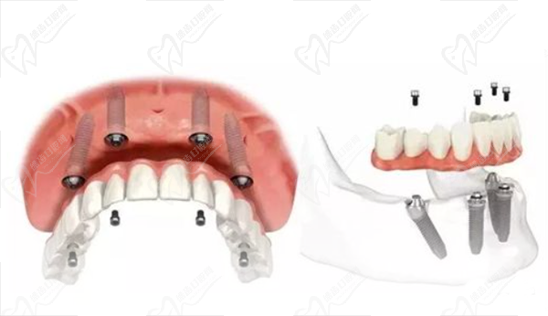 allon4全口种植牙