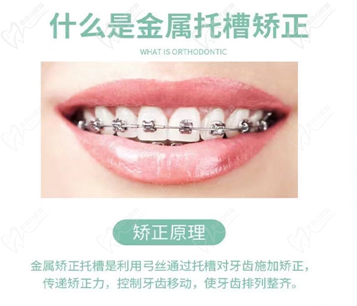 金属托槽矫正
