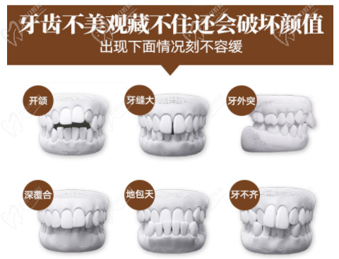 隐形矫正适合的症状