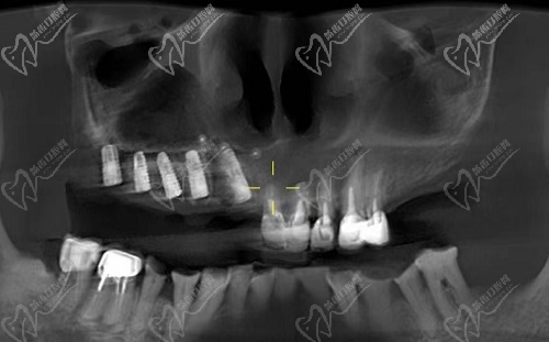 太原爱德口腔门诊部种植牙