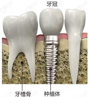 种植牙8000一般能用多久