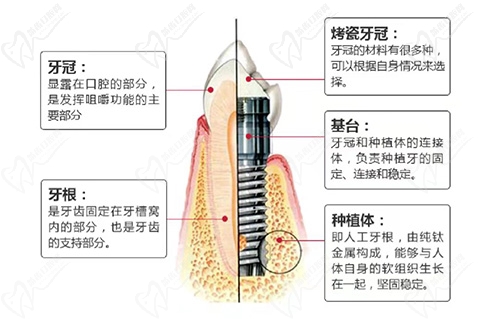 什么是种植牙