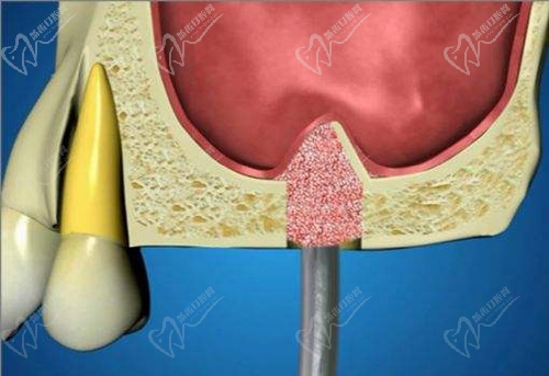 上颌窦内提升术过程图片