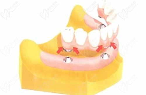 all-on-4牙齿种植技术