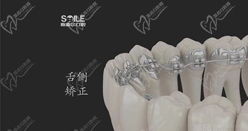 苏州斯麦尔口腔舌侧矫正