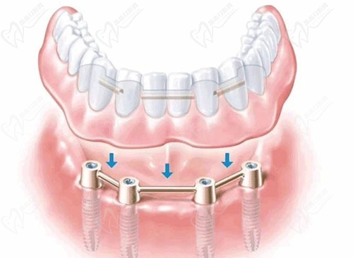 all-on-4种植牙