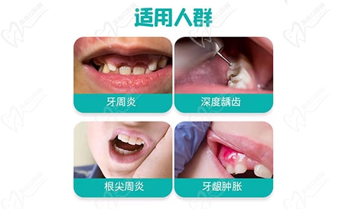 根管治疗适应人群